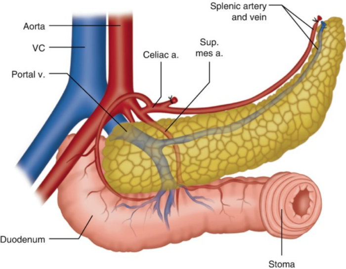 Why Pancreas Transplants are Performed