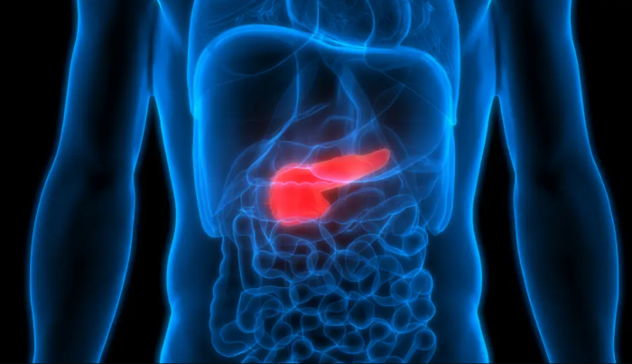 Pancreas Transplants for Type 2 Diabetes Patients