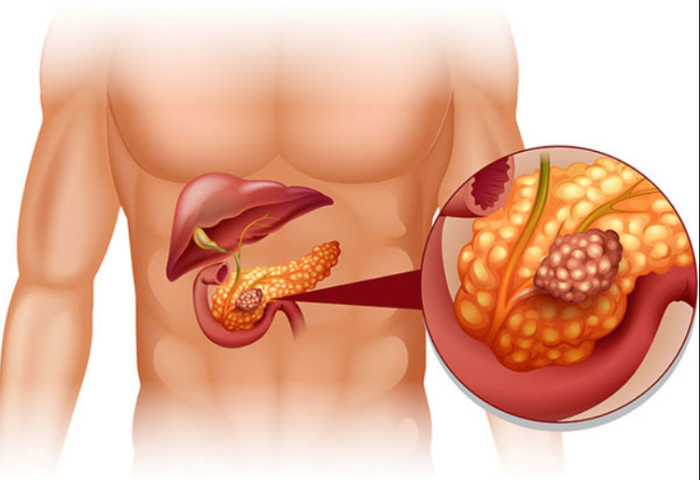 Understanding Pancreas Transplant: A Lifeline for Chronic Pancreatitis Patients