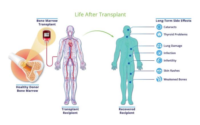 Life After Bone Marrow Transplant Surgery