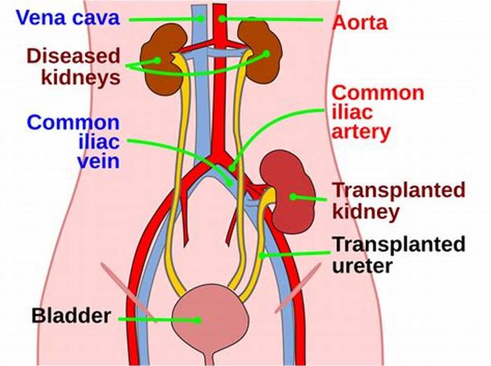  Kidney Transplant Procedure