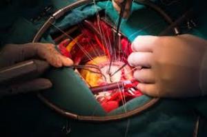 Best Mitral Valve Replacement Surgery Hospitals in India